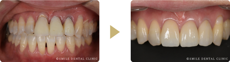審美歯科前歯の症例