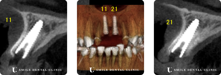 前歯２本喪失をインプラントレントゲン